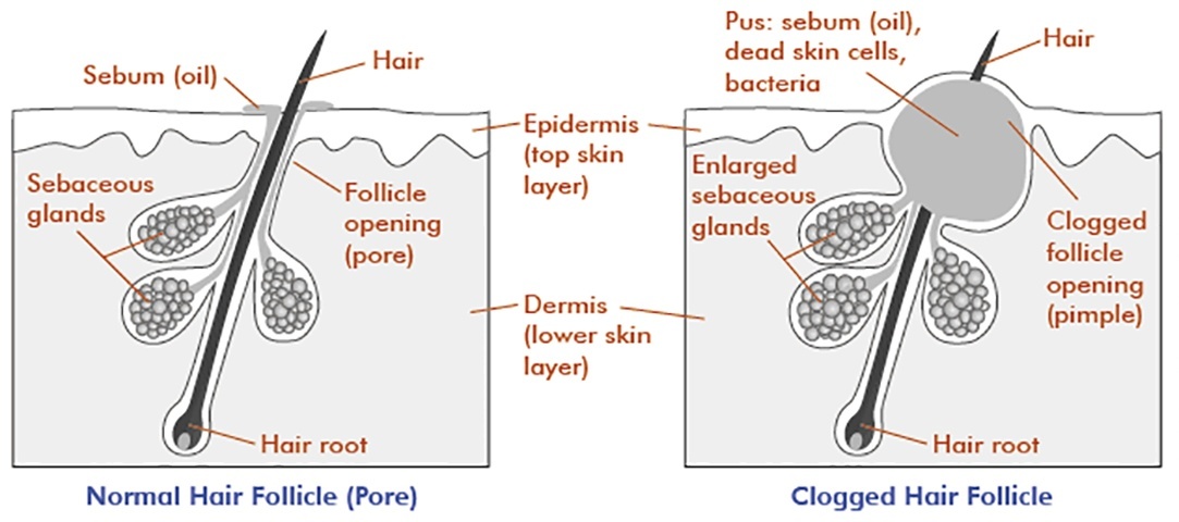 Acne Causes