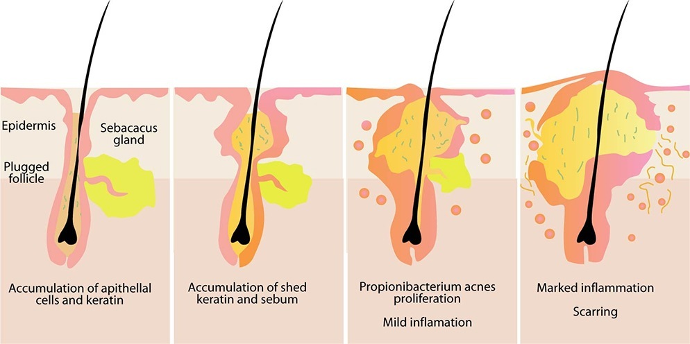 Causes of Acne