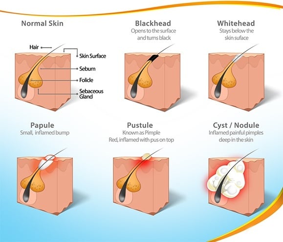 Various Types of Acne