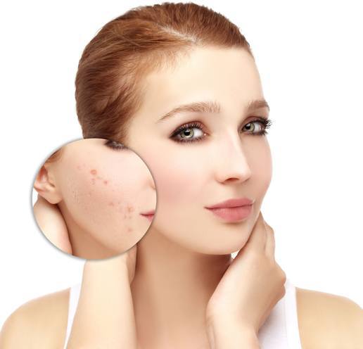 chemical peels types