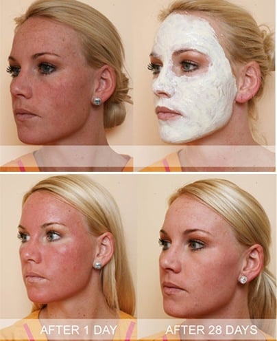 chemical peels