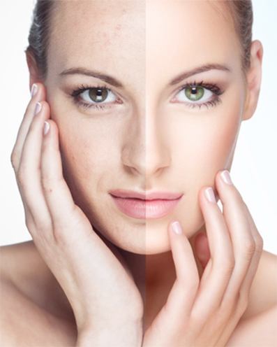 how do chemical peels work