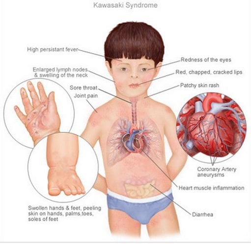 Kawasaki Disease