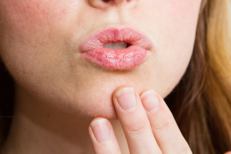 Most Common Causes Of Chapped Lips