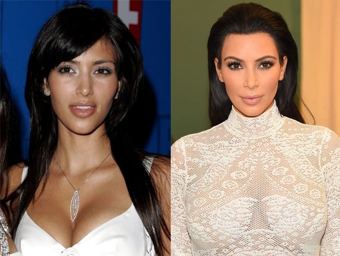 Before And After Plastic Surgery