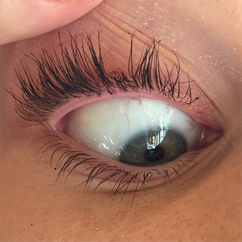 Eyelash Problem