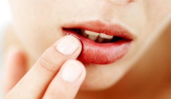 Home Remedies For Chapped Lips
