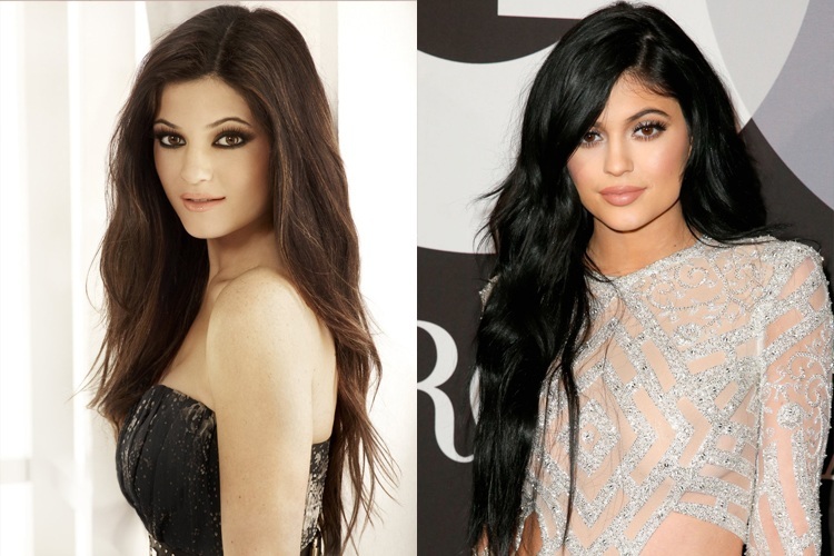 Kylie Jenner before and after surgery