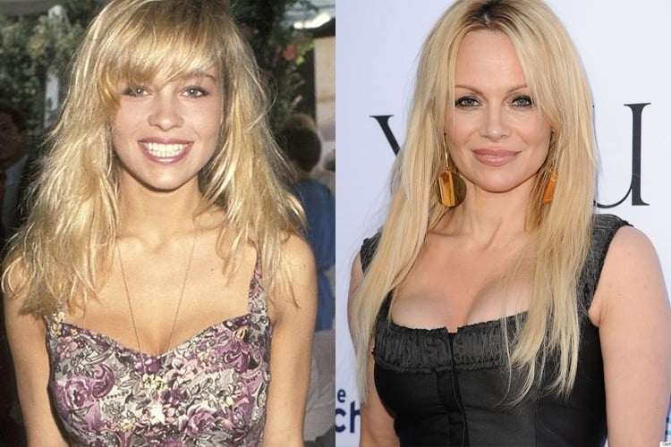 Pamela Anderson before and after plastic surgery