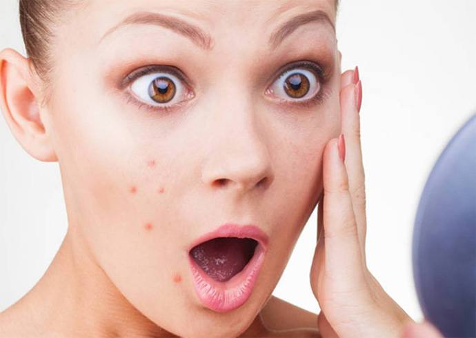 How To Remove Pimples Overnight