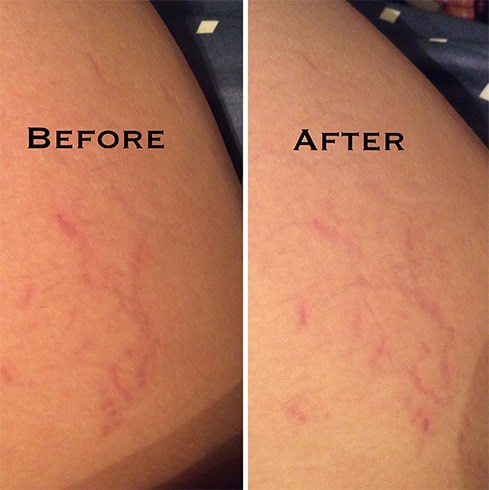 Oils For Stretch Marks