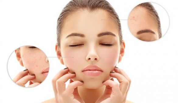 Open Pores Treatment