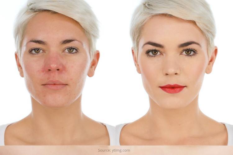 Rosacea Skin Treatment