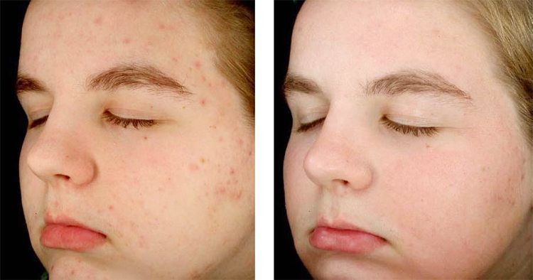 Post Peel Skin Care