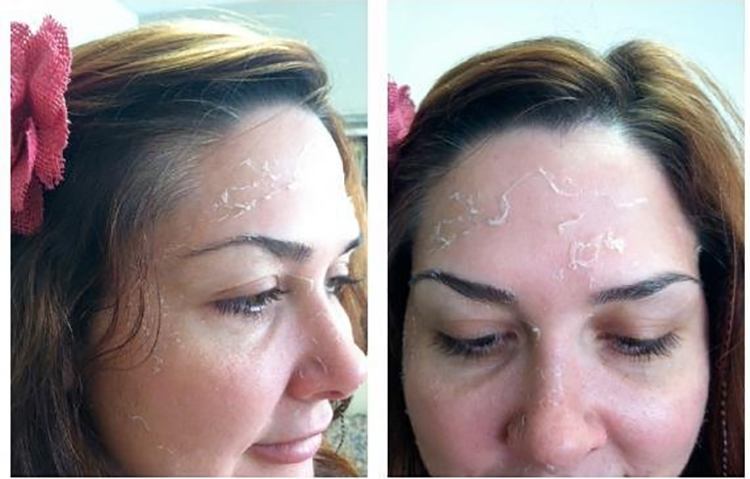 Post Peel Skin Care Treatments
