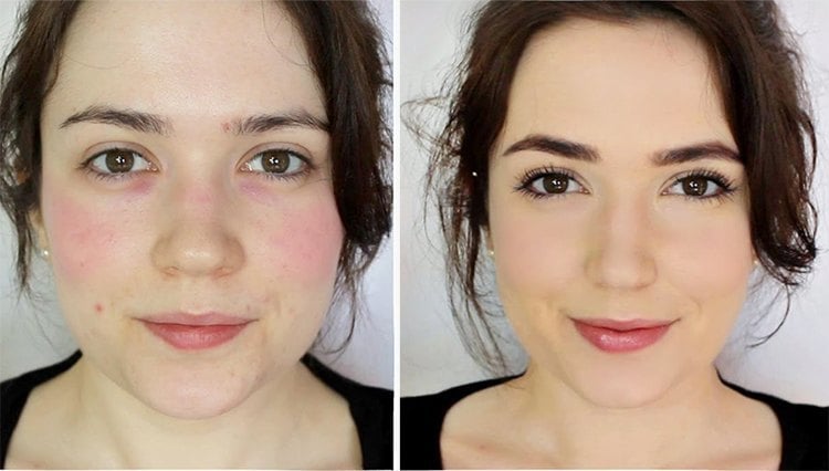 Skincare Routine For Rosacea