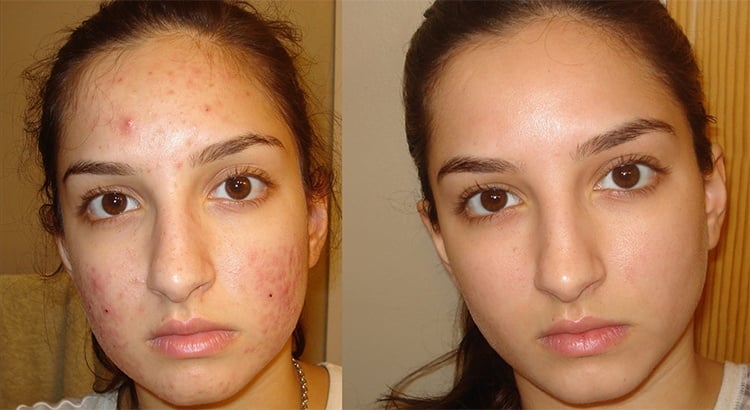 Help pimples baking soda does Surprising Ways