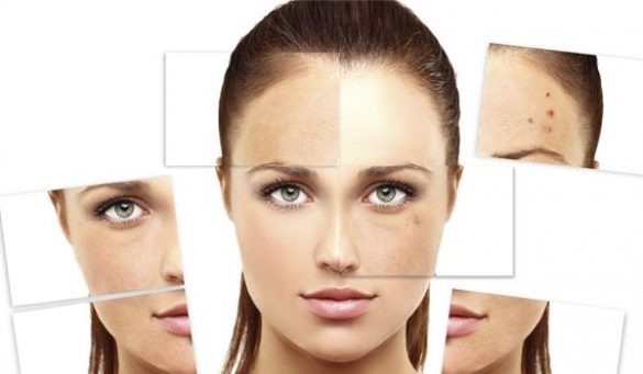 Myths About Acne