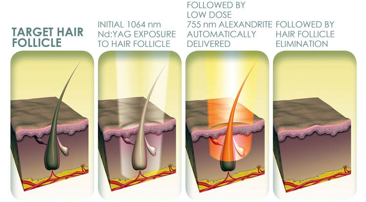 benefits of laser hair removals