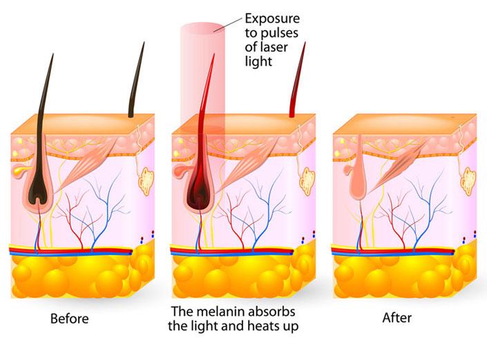 types of laser hair removal