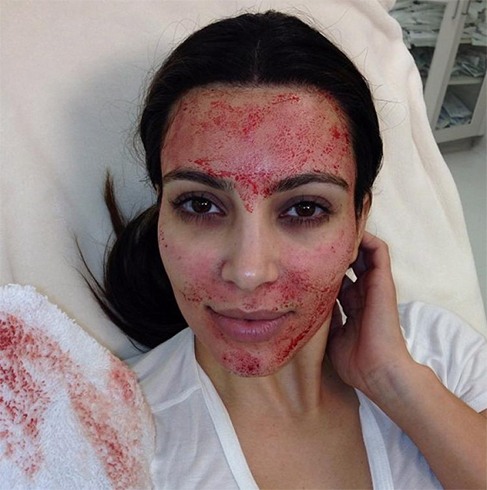 Celebrites Vampire Facials