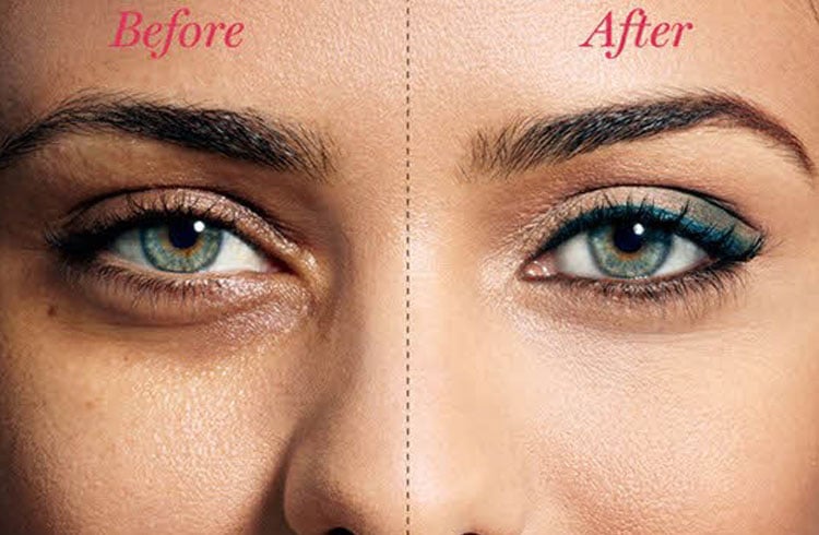 Dark Circle Remedies Before After