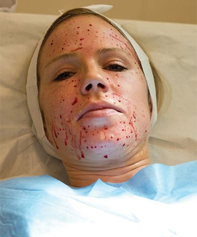 Vampire Facial For Womens