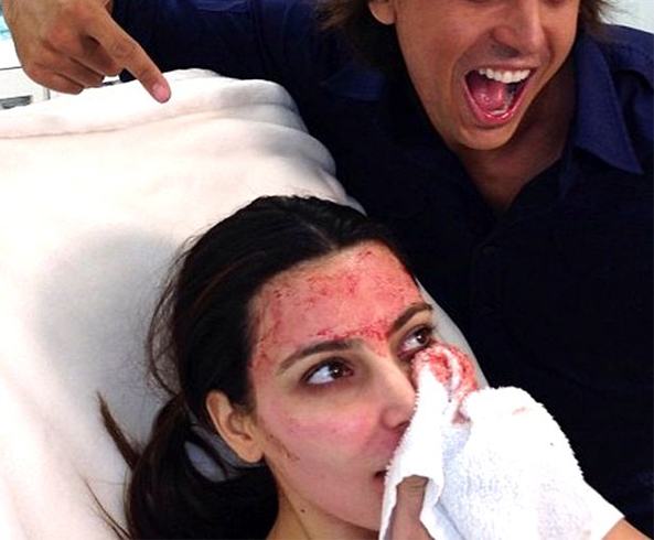 Vampire Skin Treatment
