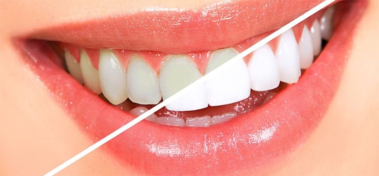 Whiten Teeth Overnight