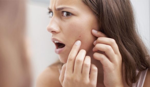 how to cover pimples