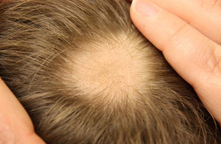 Homeopathy medicine for hair fall
