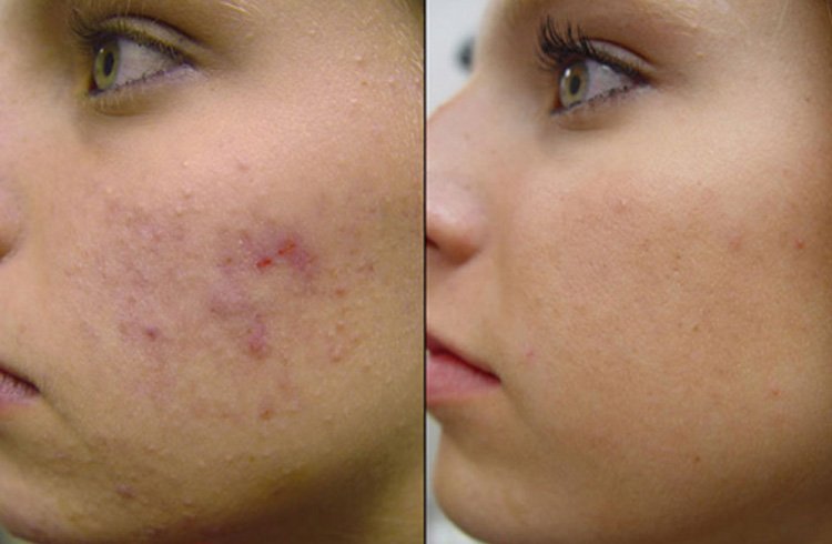 Skin dermabrasion