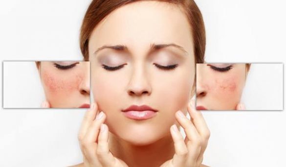 How To Reduce Redness On Face