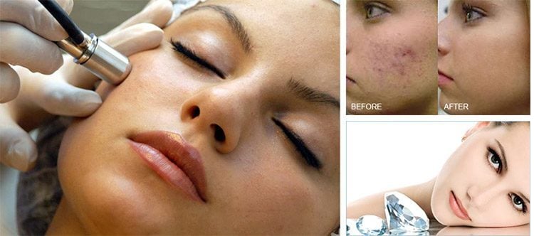 Diamond dermabrasion before and after