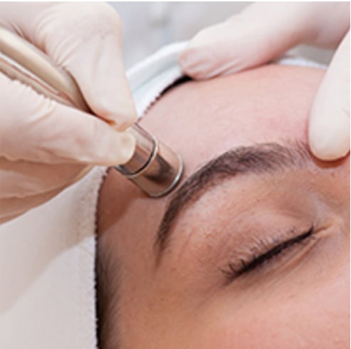 Was ist Diamond Dermabrasion und ist es besser als Microdermabrasion bei Akne?  