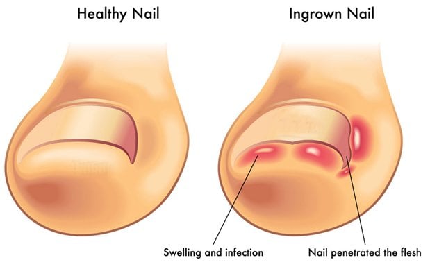 Moringa oil for Nails