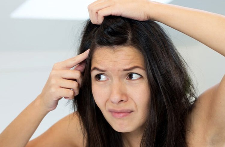 Wet Hair Causes Dandruff