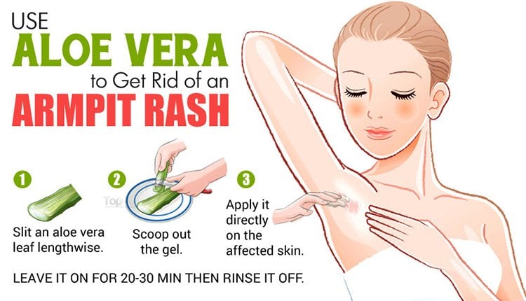 Armpit Rash Aloe Vera Remedy