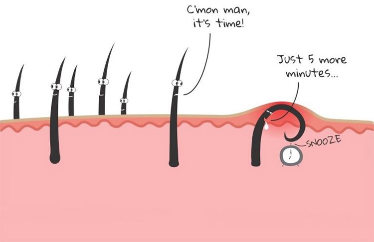 25 Amazing Ways To Get Rid Of Ingrown Hair