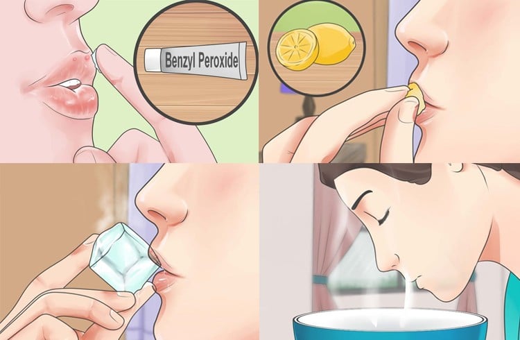 Benzoyl Peroxide for Lip Pimple Treatment