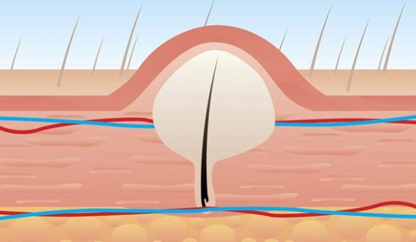 Best Ways to Get Rid of Ingrown Hair