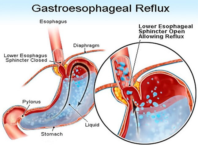 What is Heartburn