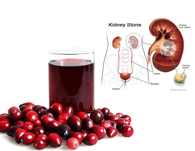 Prevents Kidney Stones