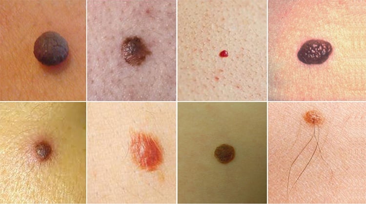 Types Of Moles