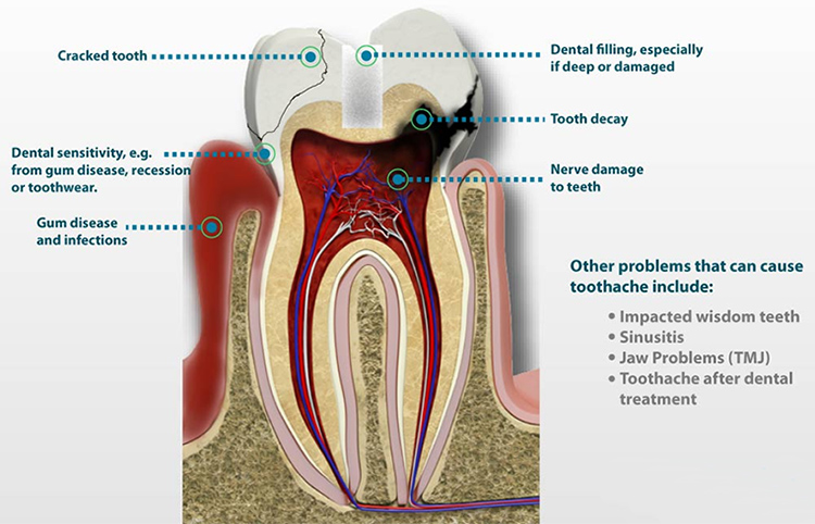 Causes of Toothche