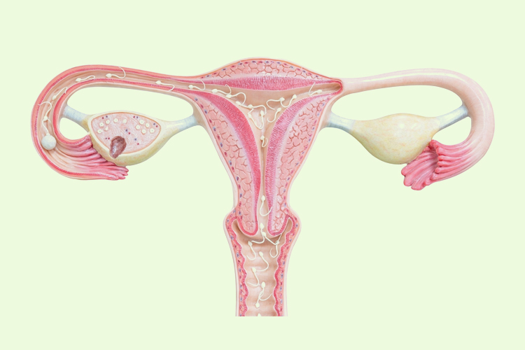 Ovarian Cysts