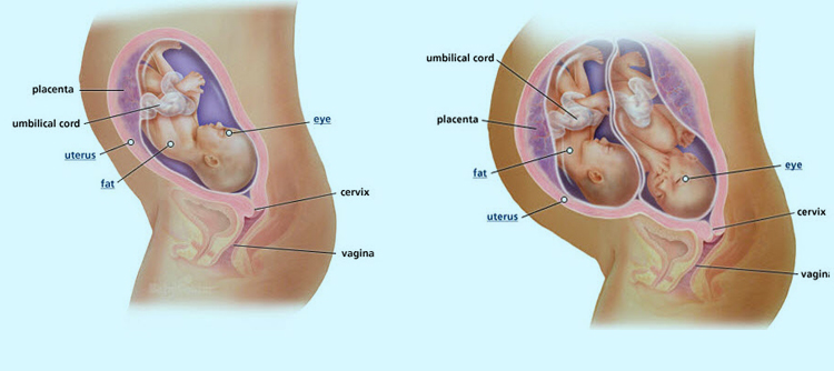 Twin Pregnancy