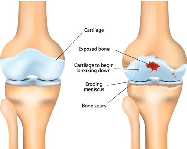 Arthritis as cause of joint pain