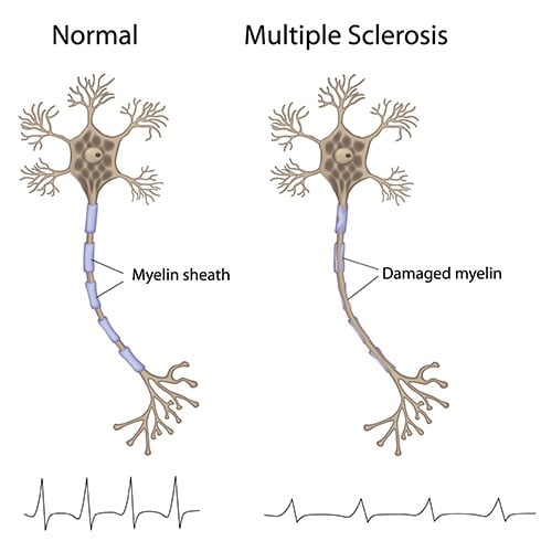 Treat Multiple Sclerosis