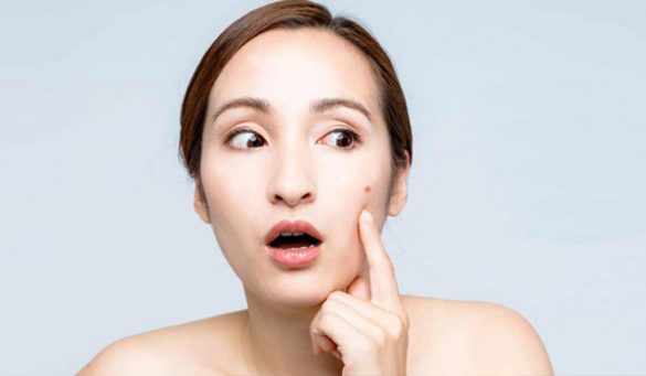 Home Remedies To Get Rid Of Boils